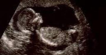 عاجل.. اكتشاف جنين داخل امرأة منذ 40 عامًا دون ان تشعر .. تفاصيل