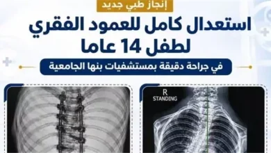 إنجاز طبى.. استعدال كامل للعمود الفقرى لطفل 14 عامًا بمستشفيات جامعة بنها
