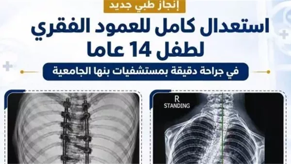 إنجاز طبى.. استعدال كامل للعمود الفقرى لطفل 14 عامًا بمستشفيات جامعة بنها